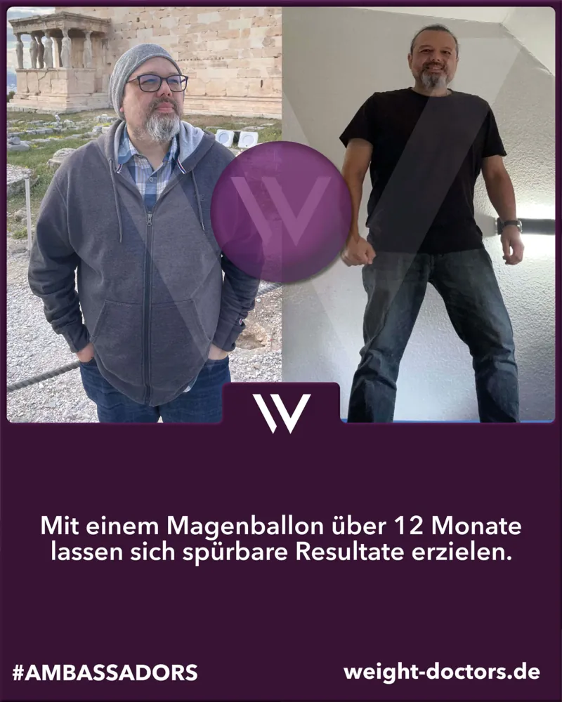 Weight Doctors® Vorher-Nachher: Patient vor und nach zwölf Monaten mit dem Weight Doctors® MAGENBALLON