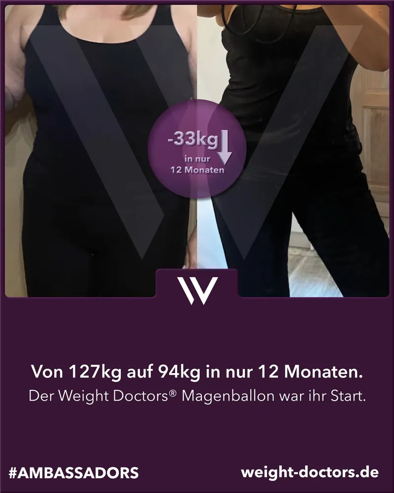 Weight Doctors® Vorher-Nachher: Patientin von 127 kg auf 94 kg in zwölf Monaten, mit dem Weight Doctors® MAGENBALLON