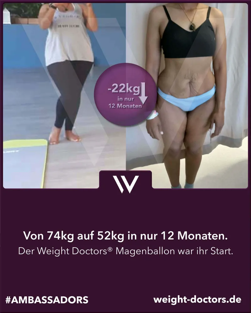 Weight Doctors® Vorher-Nachher: Patientin von 74 kg auf 52 kg in zwölf Monaten, mit dem Weight Doctors® MAGENBALLON