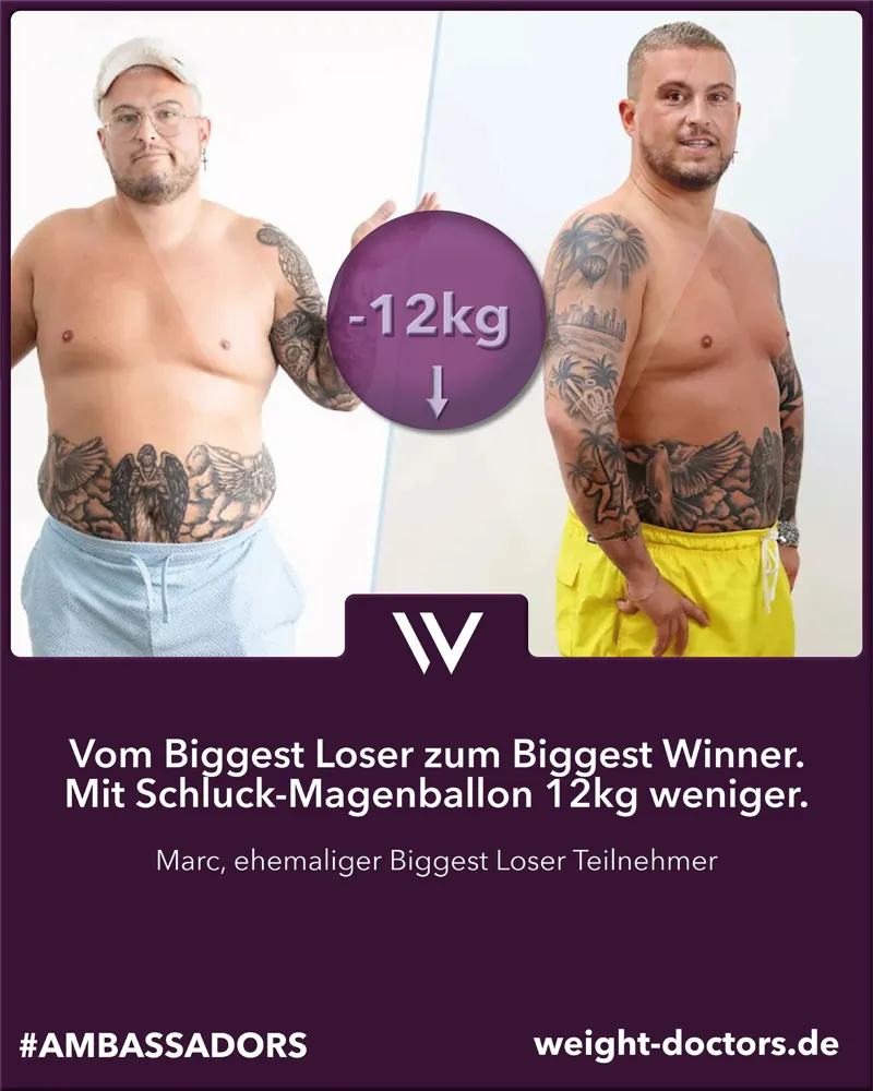 Weight Doctors® Vorher-Nachher: Marc, ehemaliger Teilnehmer bei „The Biggest Loser“, 12 kg weniger mit dem Allurion-Magenballon
