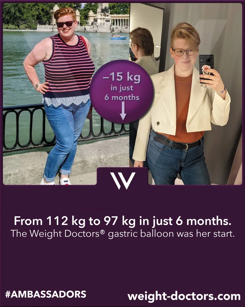 Weight Doctors® before and after: female patient from 112 kg to 97 kg in six months, with the Weight Doctors® GASTRIC BALLOON