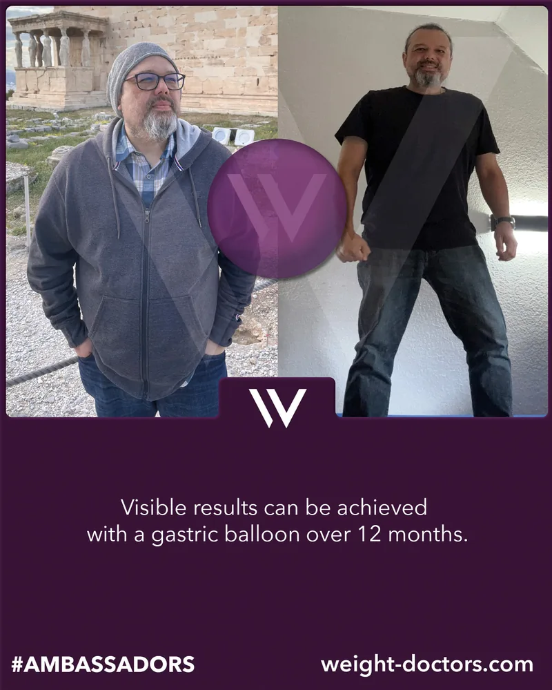 Weight Doctors® before and after: patient before and after twelve months with the Weight Doctors® GASTRIC BALLOON