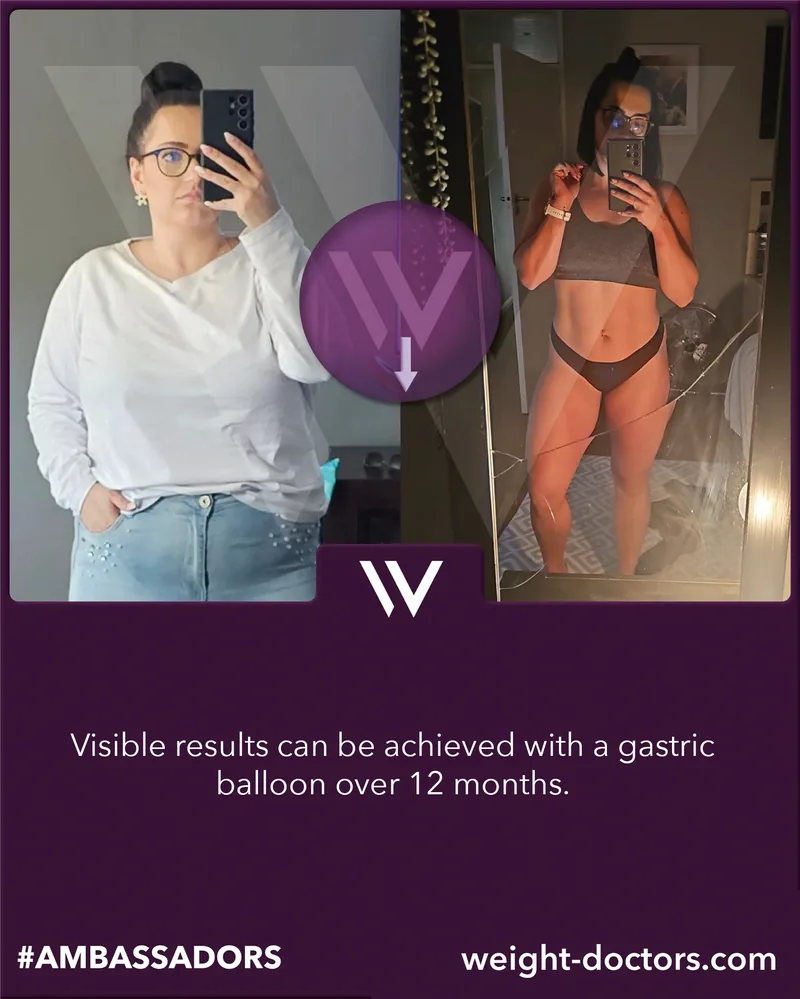 Weight Doctors® before and after: female patient before and after twelve months with the Weight Doctors® GASTRIC BALLOON