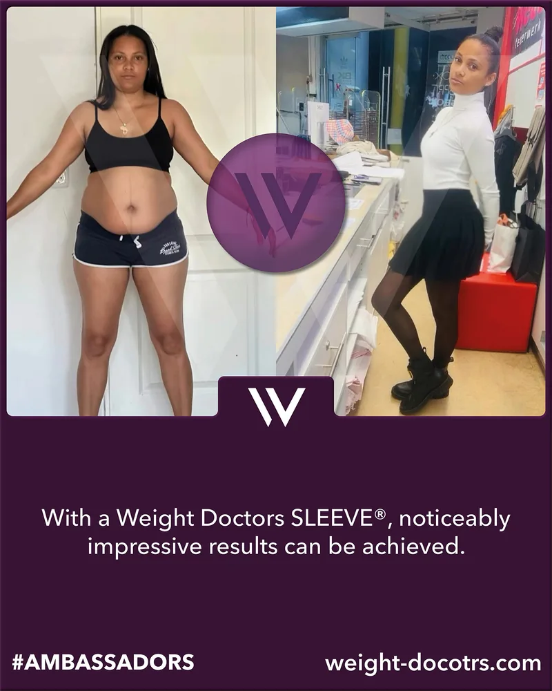 Weight Doctors® before and after: female patient before and after her Weight Doctors SLEEVE®