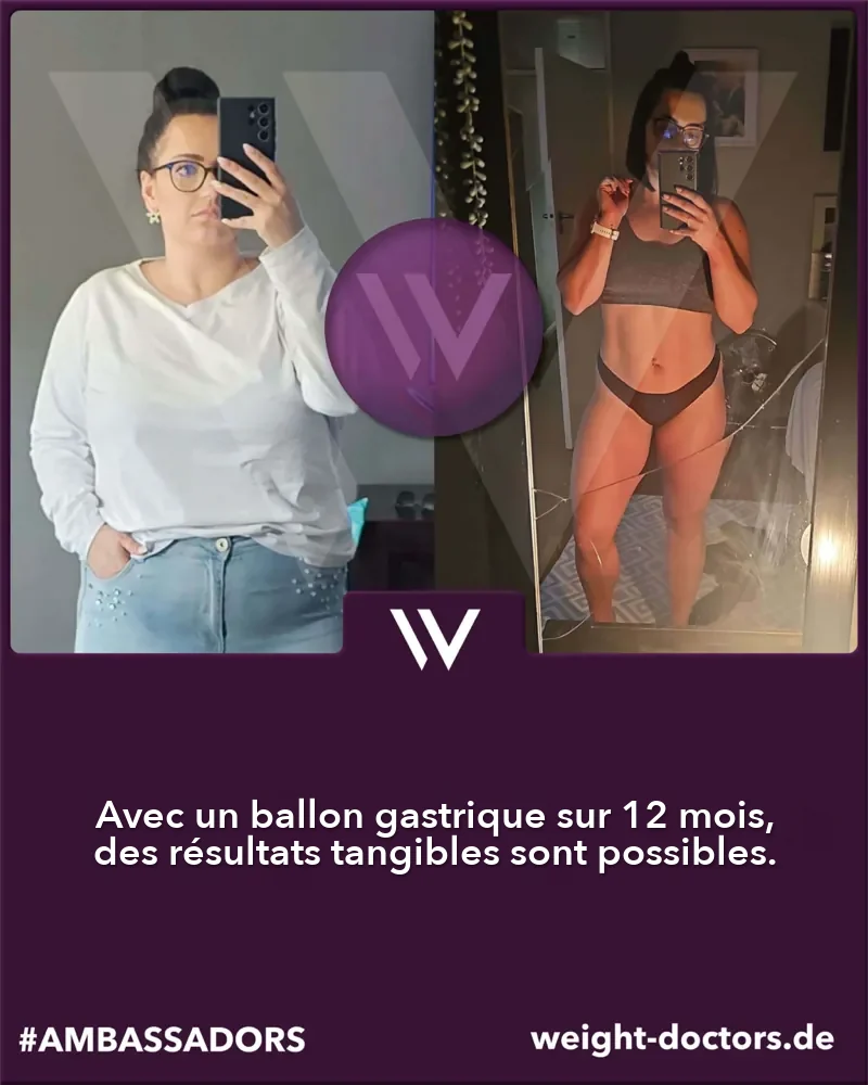 Weight Doctors® avant et après&nbsp;: patiente avant et après douze mois avec le Weight Doctors® BALLON GASTRIQUE