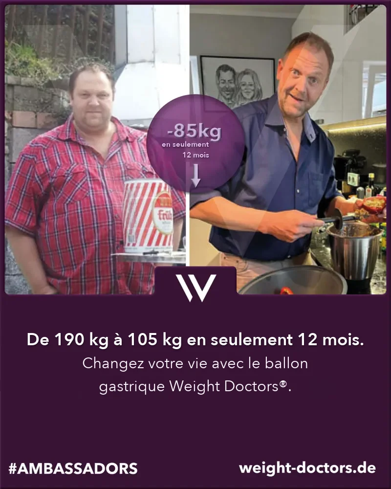 Weight Doctors® avant et après&nbsp;: patient passé de 190 kg à 105 kg en douze mois, avec le Weight Doctors® BALLON GASTRIQUE