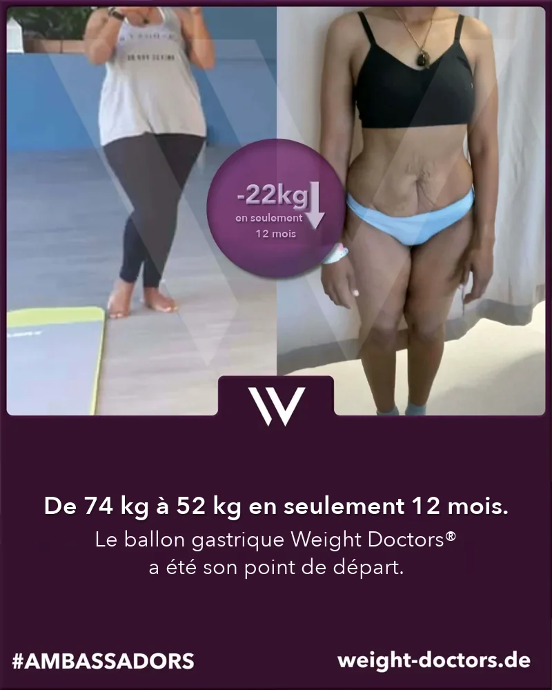Avant-après Weight Doctors®&nbsp;: une patiente passe de 74 kg à 52 kg en douze mois, avec le Weight Doctors® BALLON GASTRIQUE