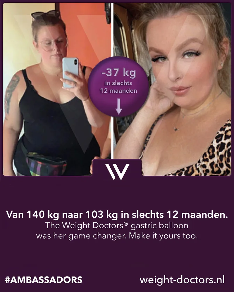 Weight Doctors® voor en na: patiënte van 140 kg naar 103 kg in twaalf maanden, met de Weight Doctors® MAAGBALLON
