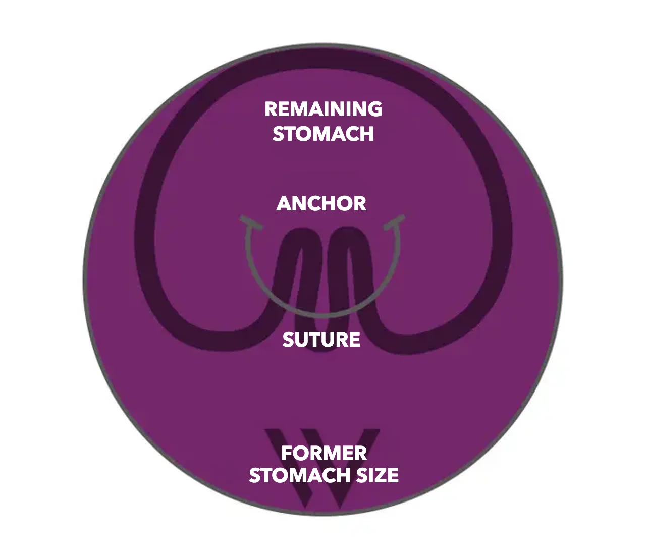 Diagram of pose® 3.0 Double Helix: anchors and suture fold the stomach wall, the remaining stomach is significantly smaller than the former stomach size