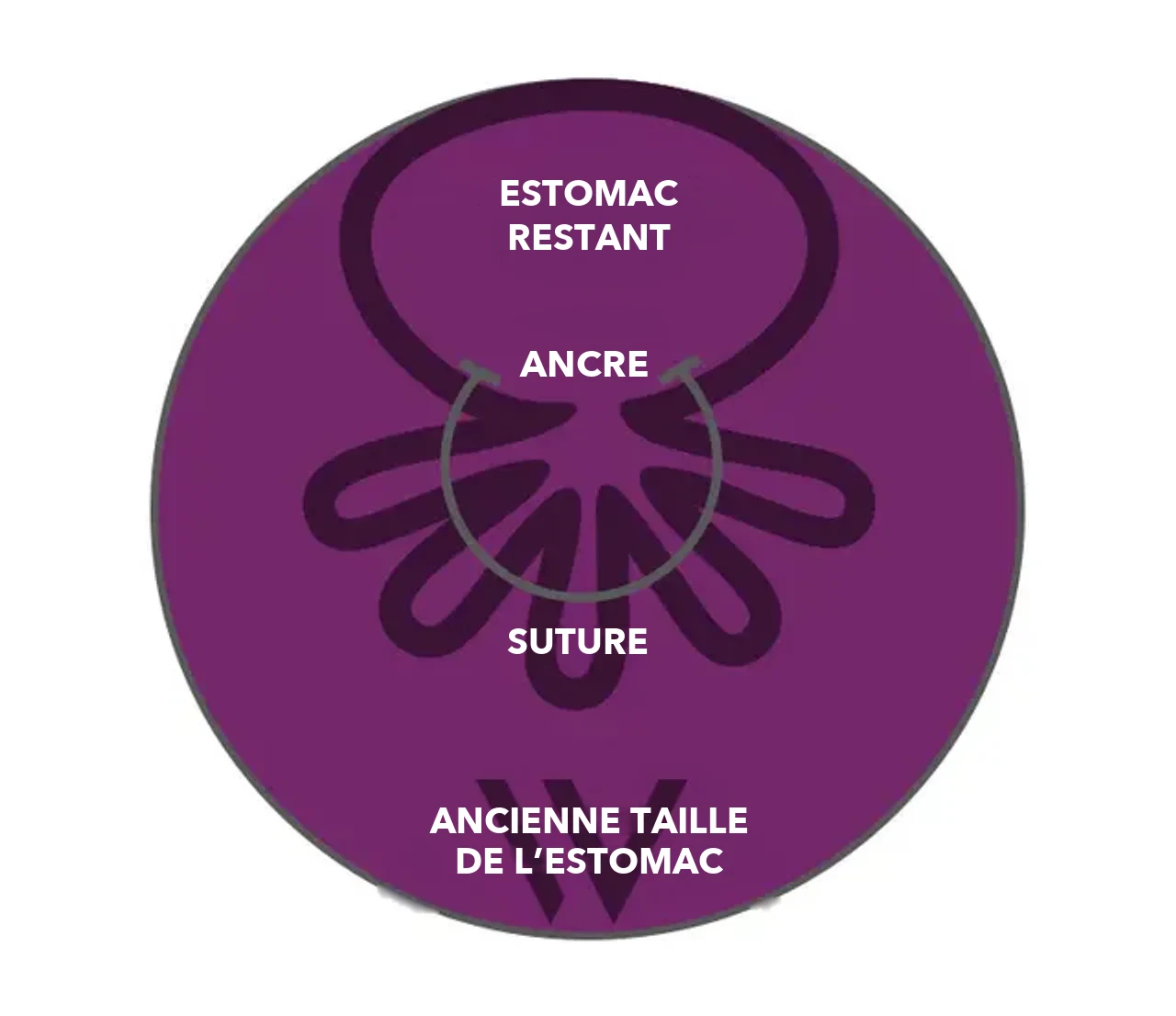 Schéma OverStitch NXT™&nbsp;: les ancres et la suture resserrent la paroi de l’estomac, l’estomac restant est nettement plus petit que l’ancienne taille de l’estomac