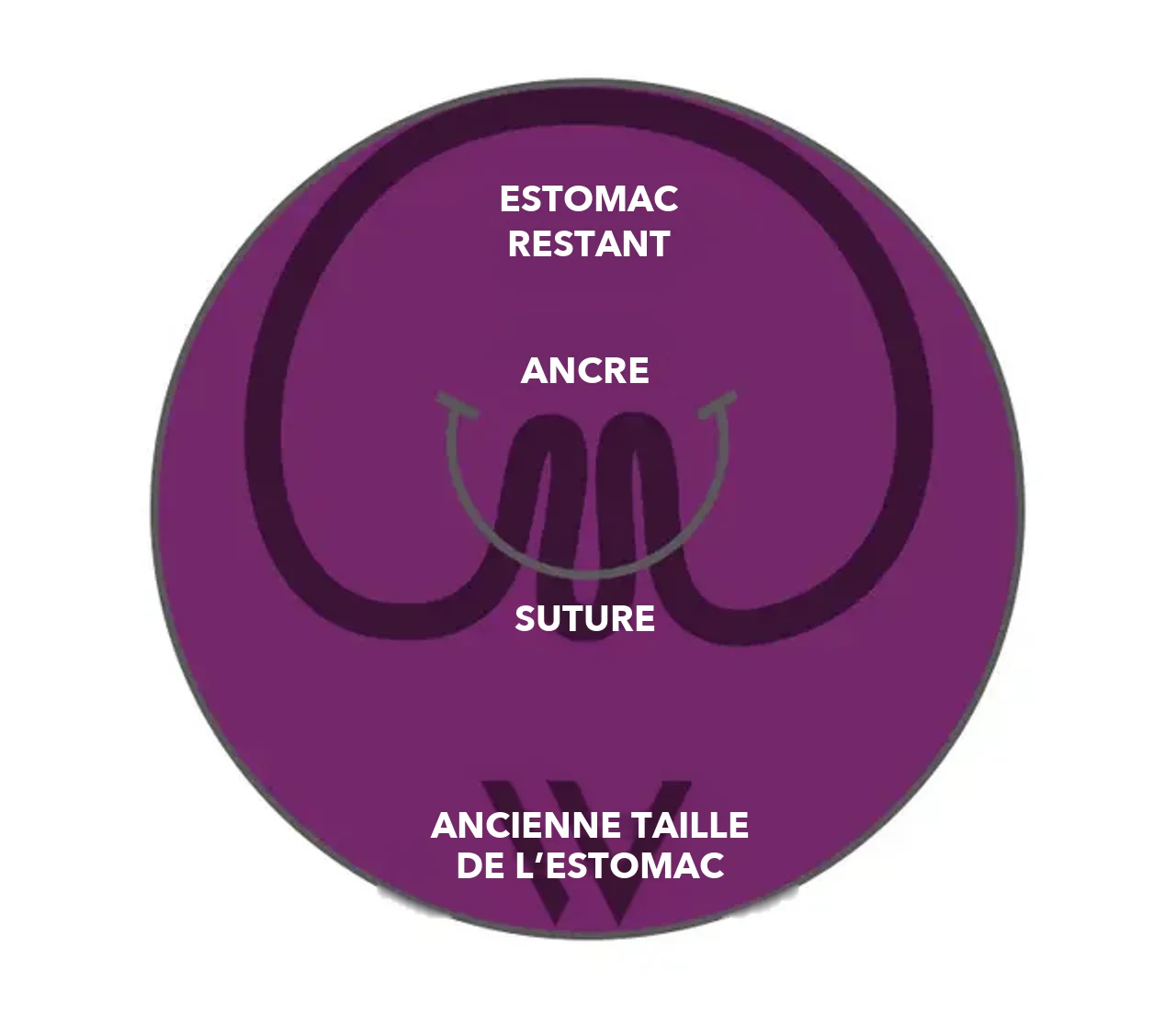 Schéma : estomac après le plissement avec pose® 3.0 Double Helix – estomac restant, ancres et suture à l’intérieur de l’ancienne taille de l’estomac