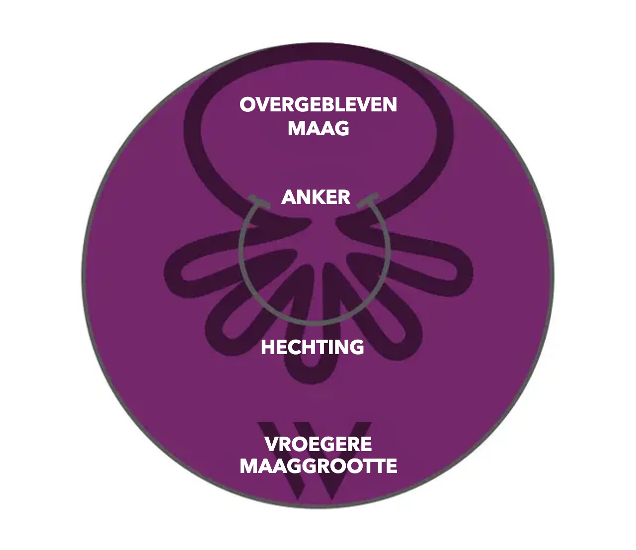 Schema OverStitch NXT™: anker en hechting trekken de maagwand samen, de resterende maag is duidelijk kleiner dan de vroegere maaggrootte