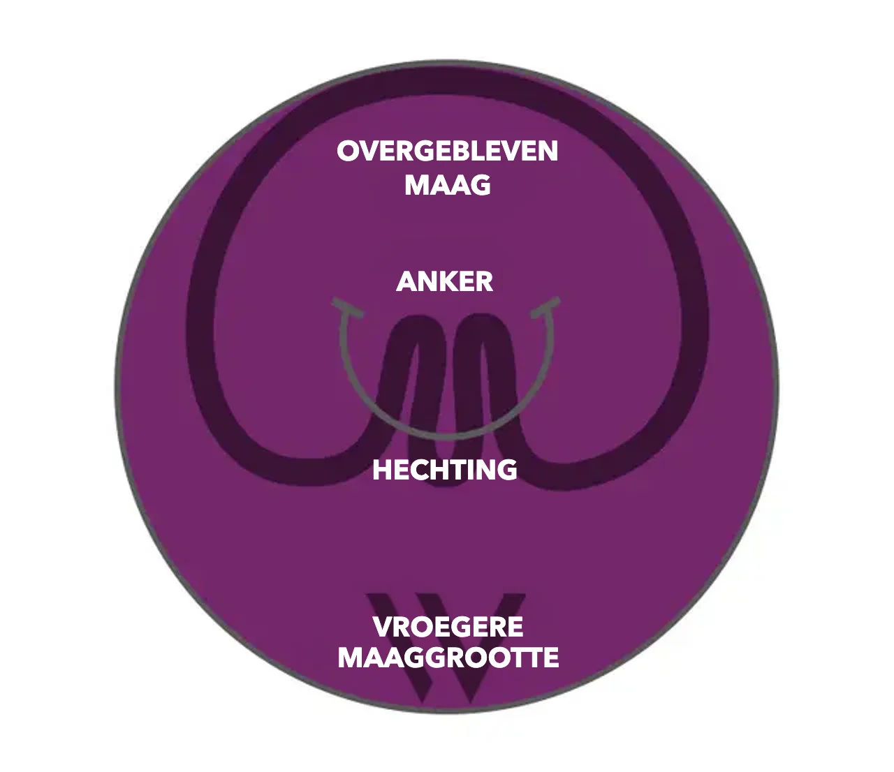 Schema pose® 3.0 Double Helix: ankers en hechting plooien de maagwand, de resterende maag is duidelijk kleiner dan de vroegere maaggrootte