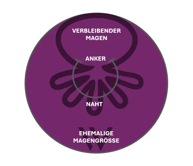 Schema OverStitch NXT™: Anker und Naht raffen die Magenwand, der verbleibende Magen ist deutlich kleiner als die ehemalige Magengröße