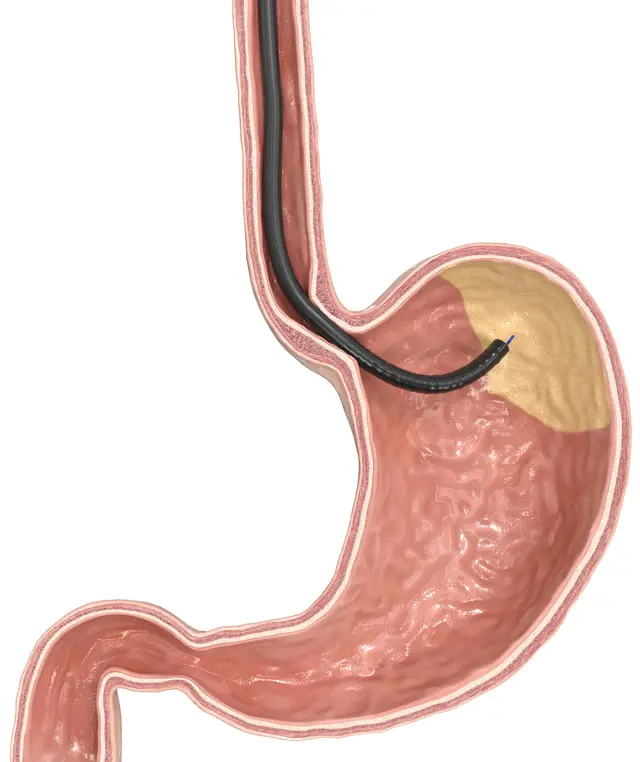 Illustration der gastralen Mukosa-Ablation: Endoskop im Magen, der Fundus (Magenblase) mit den Ghrelin-bildenden Zellen ist hervorgehoben
