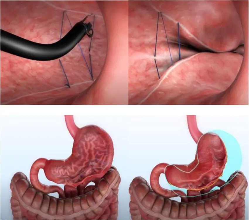 Suture endoscopique avec OverStitch NXT™ : en haut, l’endoscope suturant la paroi gastrique ; en bas, l’estomac avant et après, avec l’ancienne taille marquée