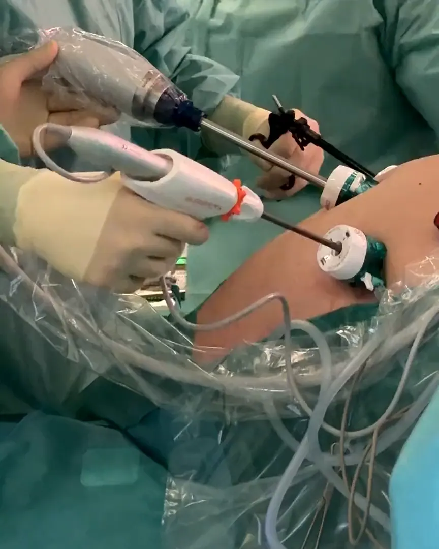 Les mains de l’équipe opératoire guident les instruments par de petits accès dans la paroi abdominale